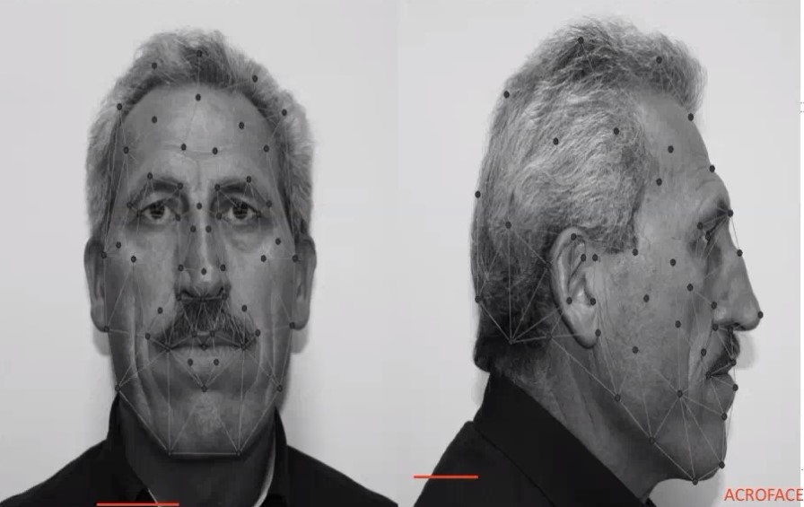 El dispositiu, en fase de prototip, permet diagnosticar precoçment un 80% les persones amb la malaltia abans de l'aparició de símptomes.